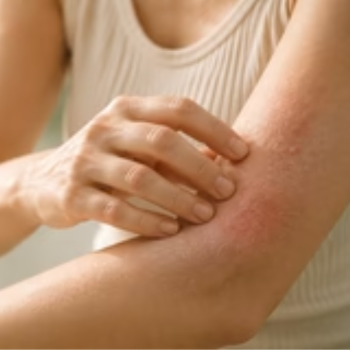 Eczema & Psoriasis